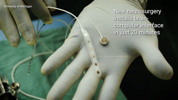 Brain implant for epilepsy tested in 20-minute surgery