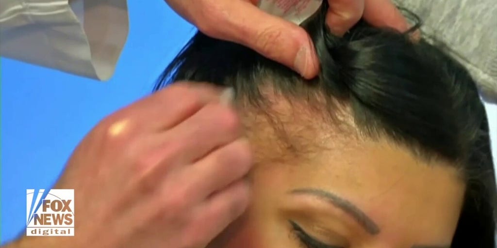 High-Tech techniques for battling GLP-1 hair loss