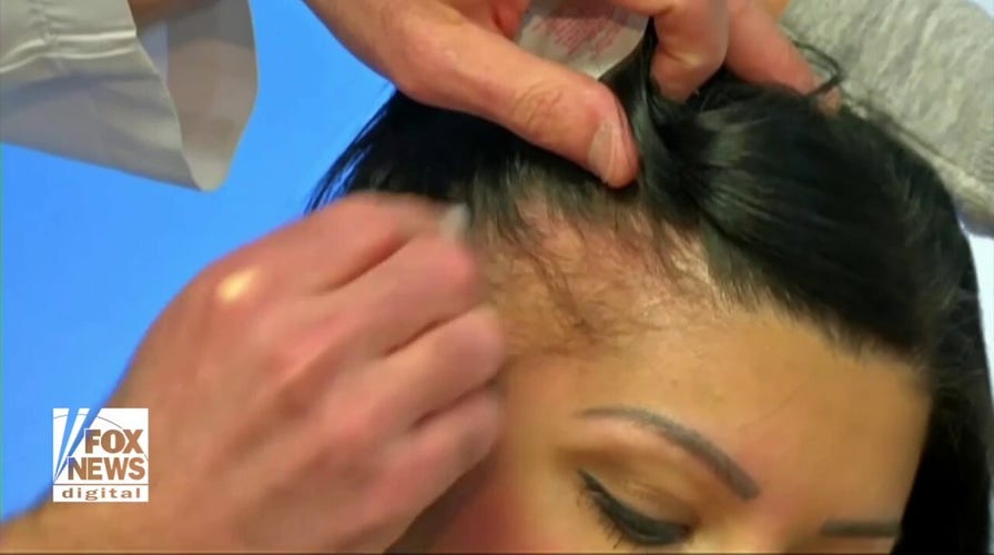 High-Tech techniques for battling GLP-1 hair loss