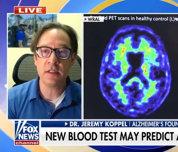 New blood test may predict Alzheimer's disease risk