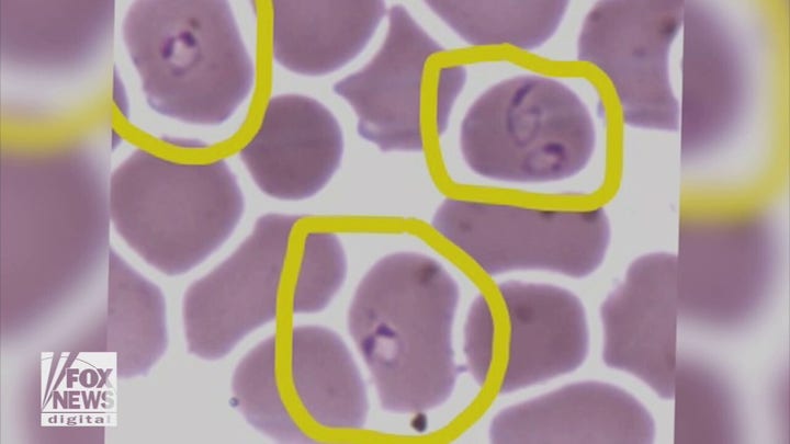 First malaria outbreak in 20 years hits US