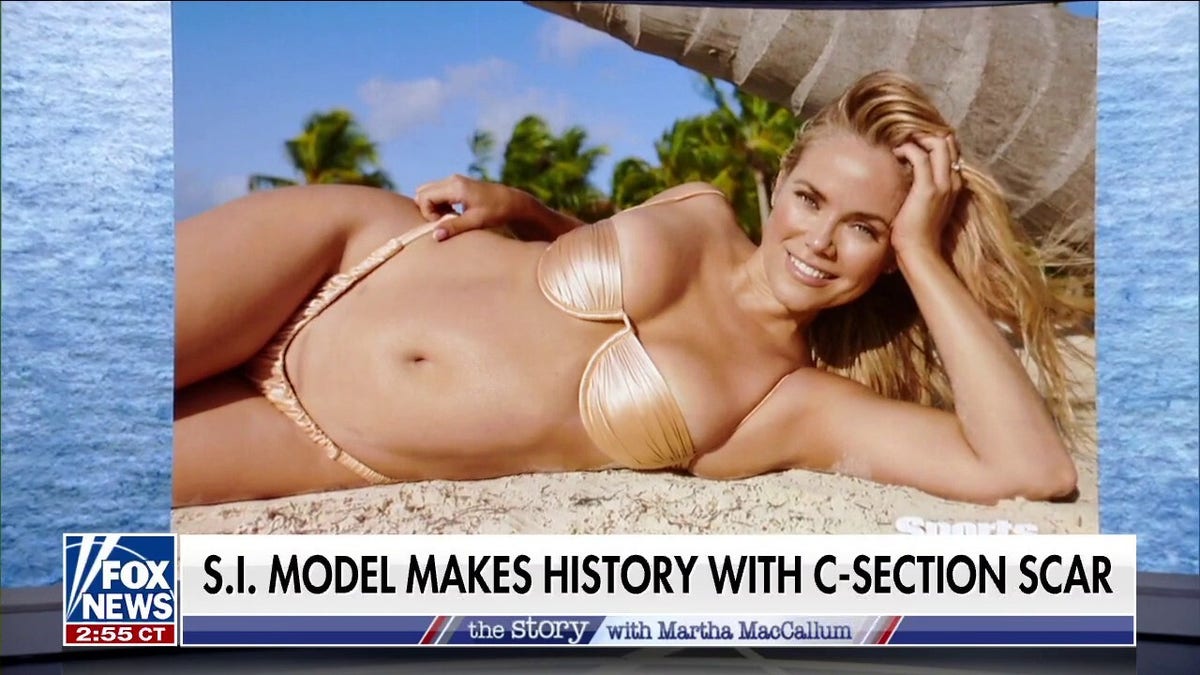 Sports Illustrated model photographed with C section scar makes history