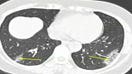 CT scans could accurately diagnose coronavirus