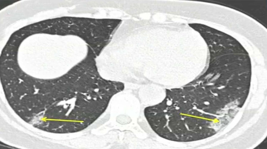 CT scans could accurately diagnose coronavirus