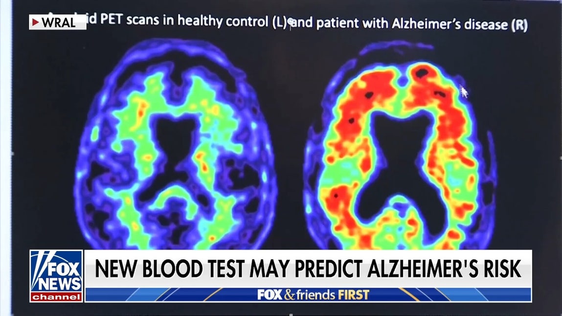 New blood test may predict Alzheimer's risk