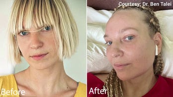 ‘Chandelier’ singer Sia’s plastic surgeon explains why she wanted to be honest about her facelift