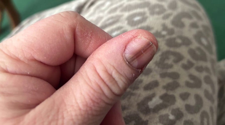 Strange warning sign leads to Ohio mom's diagnosis of rare skin cancer