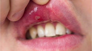 Is a canker sore causing your mouth pain? - Fox News