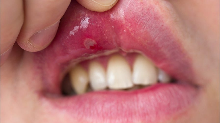 Is a canker sore causing your mouth pain?