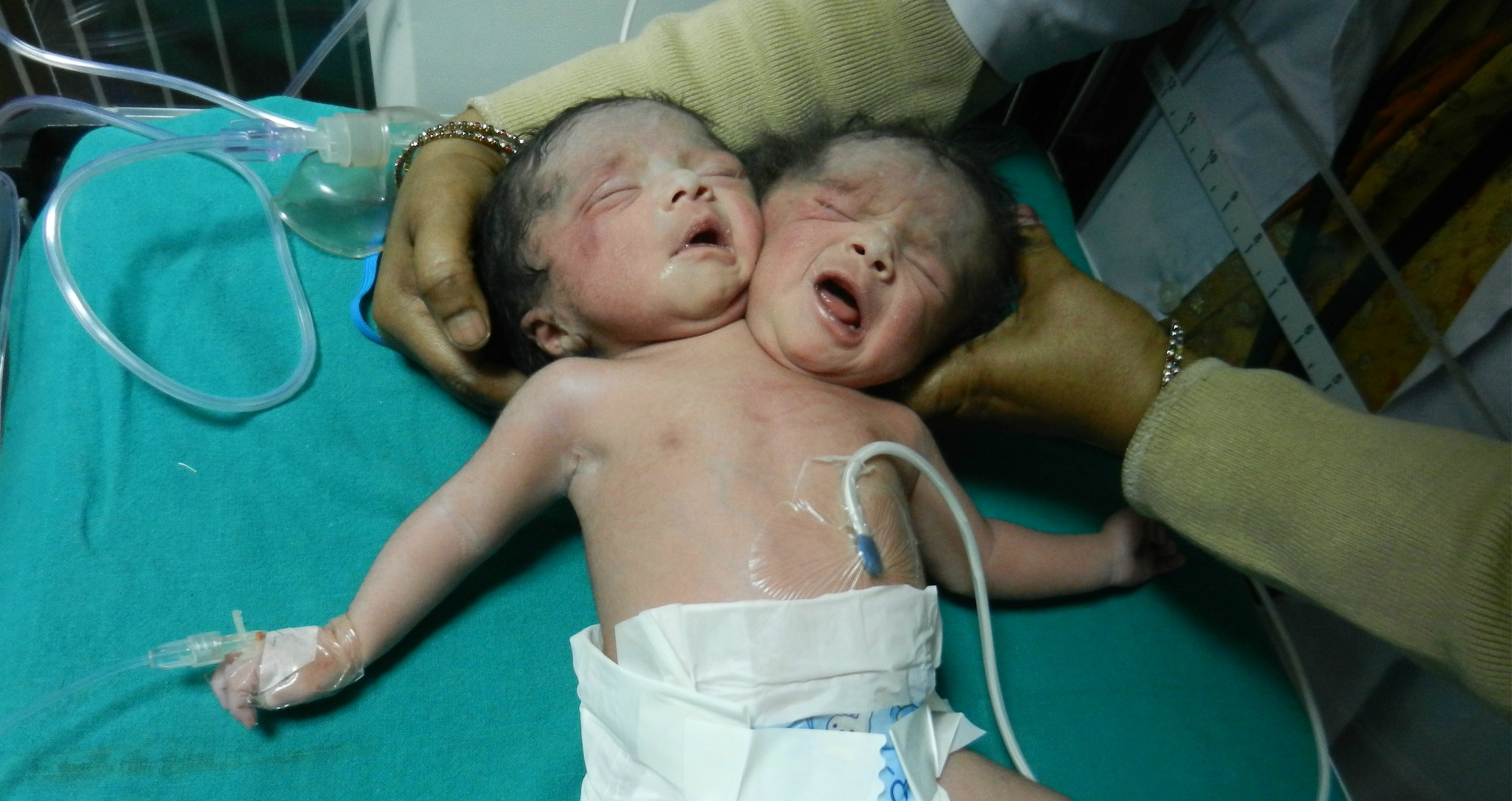 headed baby born in India | Fox News