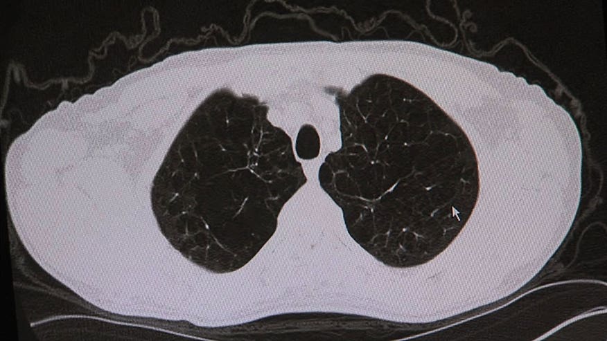 Study looks into better screening tools for lung cancer | Fox News