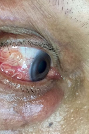 Live worm pulled from man's EYE