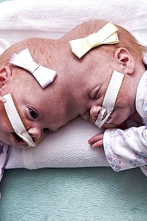 Conjoined twins separated, thriving