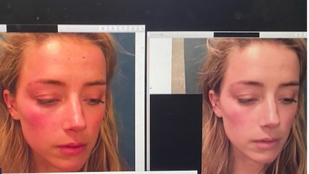 Johnny Depp's lawyer accuses Amber Heard of 'enhancing' photos of her injuries