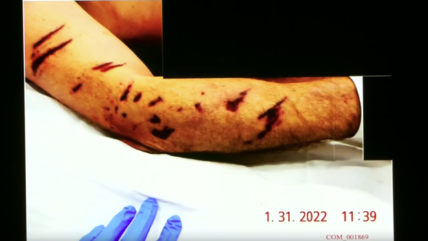 Doctor testifies that John O'Keefe's arm injuries came from 'dog attack'