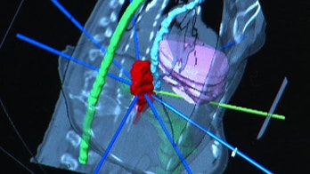 First stent graft used to help treat heart cancer