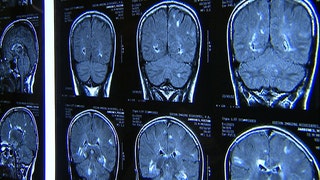 New treatment for multiple sclerosis - Fox News