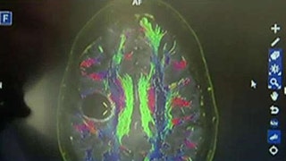 New technology gives hope to brain cancer patients - Fox News