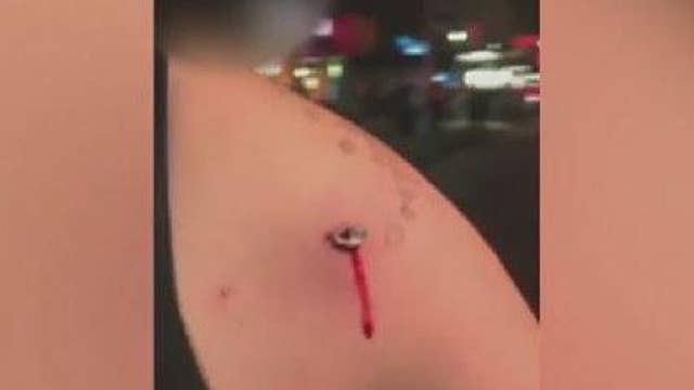 Victim of NYC blast shows shrapnel wound