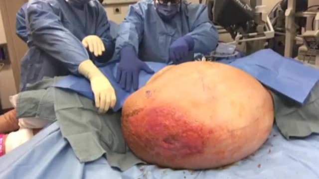 Surgeons remove 140-pound tumor from 71-year-old grandmother