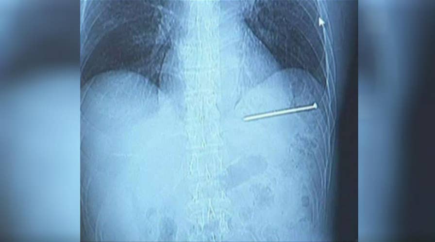 Wisconsin man shoots nail into his heart, survives