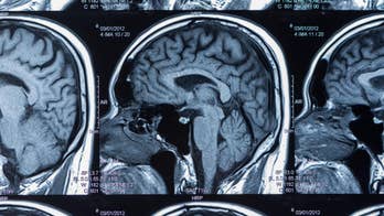 Brain damage from football concussions varies by position and career duration