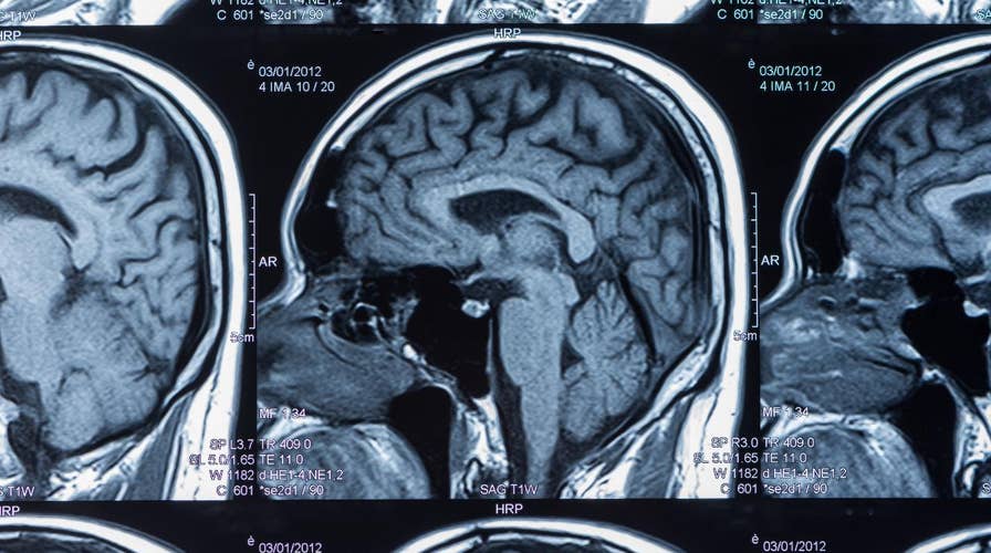 A medical breakthrough in CTE research on NFL players