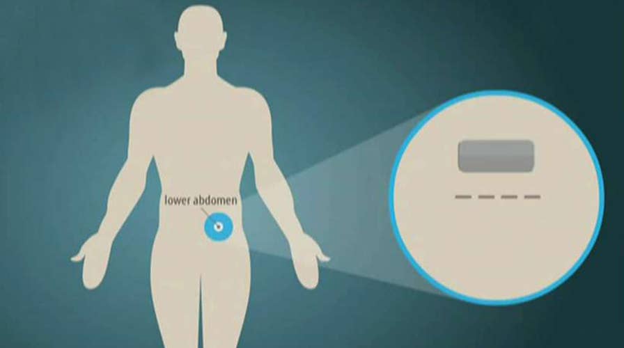 Opioid implants being used to help addicts recover