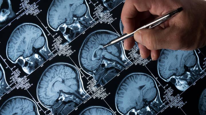 Diabetes drug may reverse Alzheimer’s symptoms