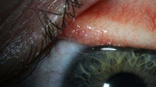 Oregon woman has 14 worms pulled from eye after rare infection - Fox News