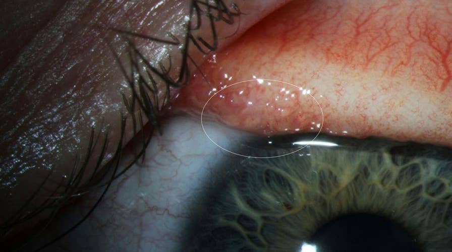 Oregon woman has 14 worms pulled from eye after rare infection