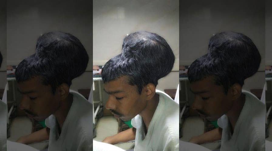 Indian doctors remove four-pound brain tumor