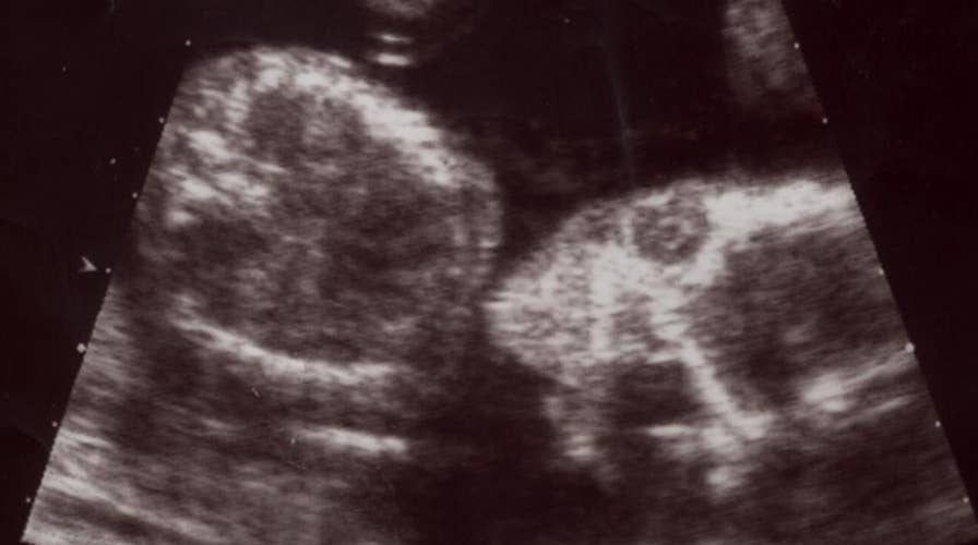 Op-ed argues for the right to abort fetus with Down syndrome