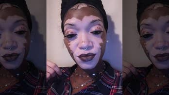 A woman with a blotchy skin disease finds the courage to go makeup-free after 30 years of 'wearing a mask'
