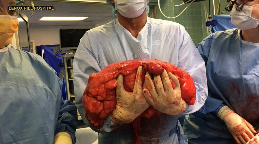 Man’s beer belly turns out to be 30-pound cancer tumor