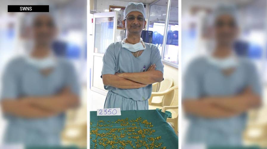 Outrageous surgery: Doctors remove 2,350 gallstones from woman’s gallbladder 