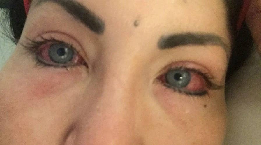 DANGEROUS: Instagram model partially blind after eye color surgery