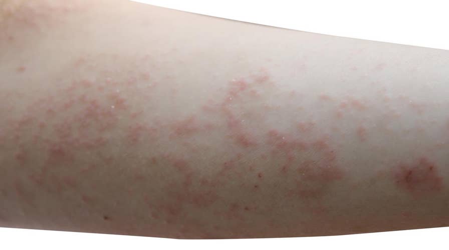 What is scabies?