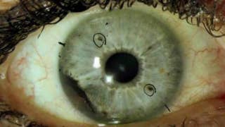 What is ocular melanoma? - Fox News