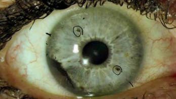 Dozens develop rare eye cancer in a case that's baffling doctors