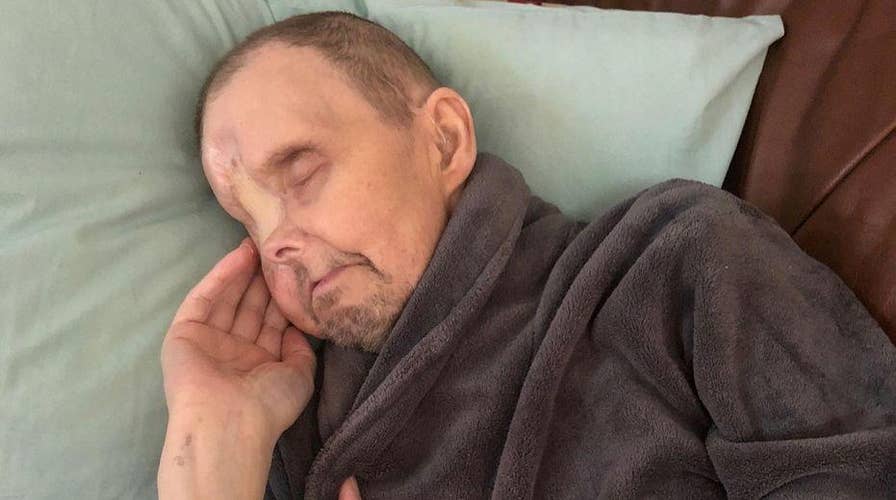 Eye cancer misdiagnosed as migraine eats giant hole in man's face