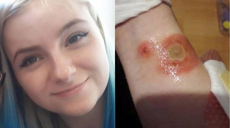 'Deodorant Challenge' leaves teen with second-degree burns