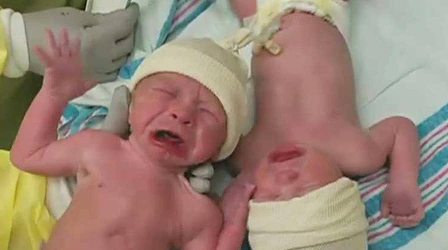 Newborn twins not ready to separate after birth
