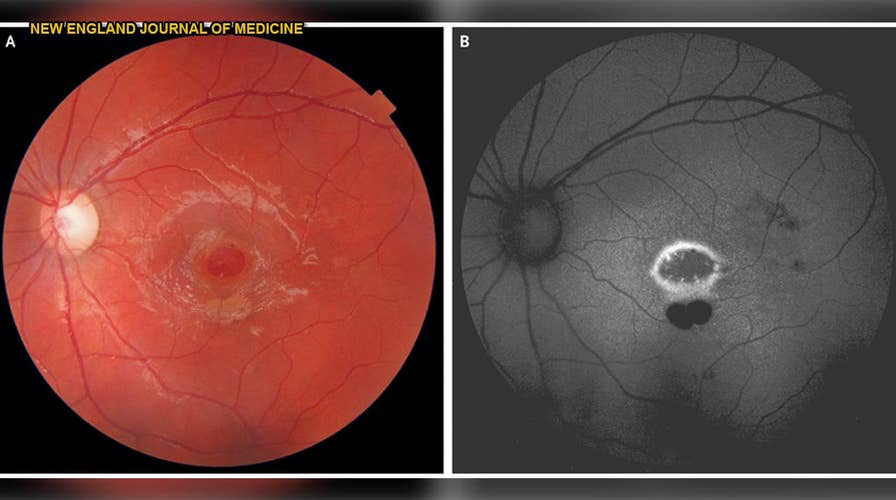 Laser pointer burns hole in boy's retina