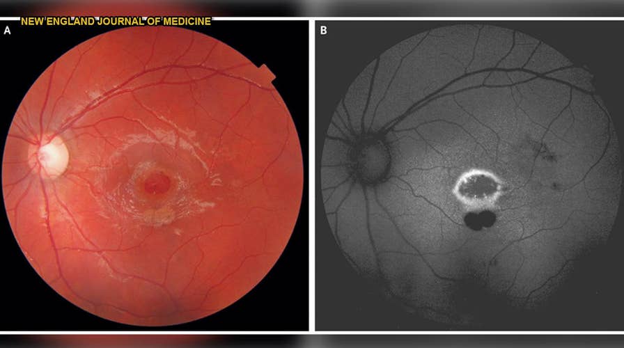 Laser pointer burns hole in boy's retina