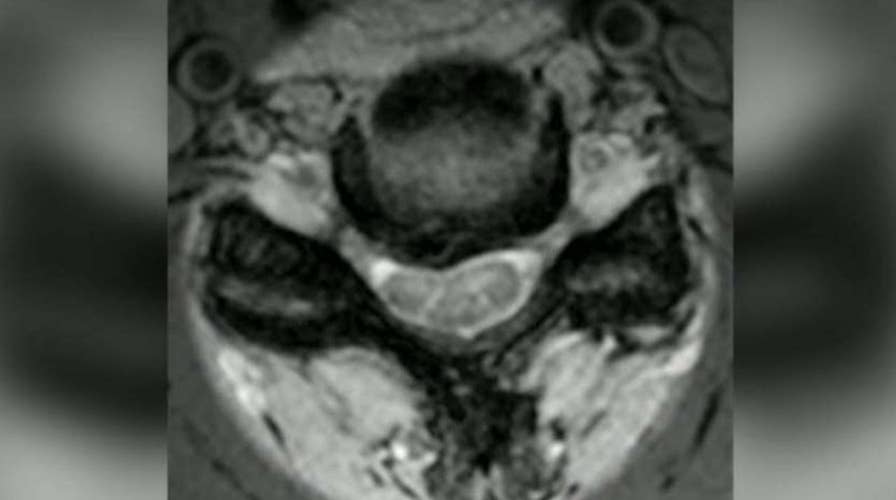 Explaining cervical myelopathy