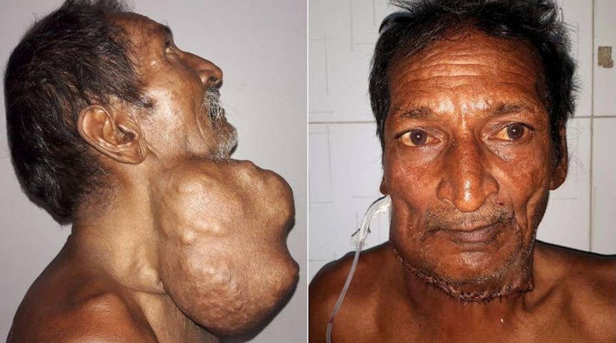 Man gets a 3-pound tumor removed from his neck