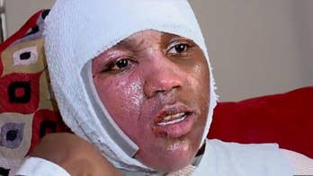 'Hot Water Challenge' reportedly leaves teen with second-degree burns