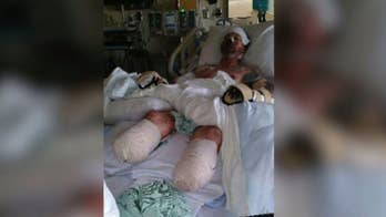 Man has 4 limbs amputated after dog lick leads to severe infection, report says