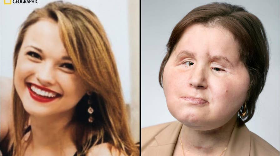Girl receives ‘face transplant’ after suicide attempt